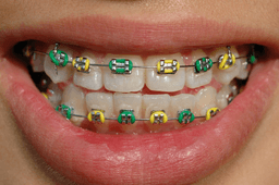 smile with braces